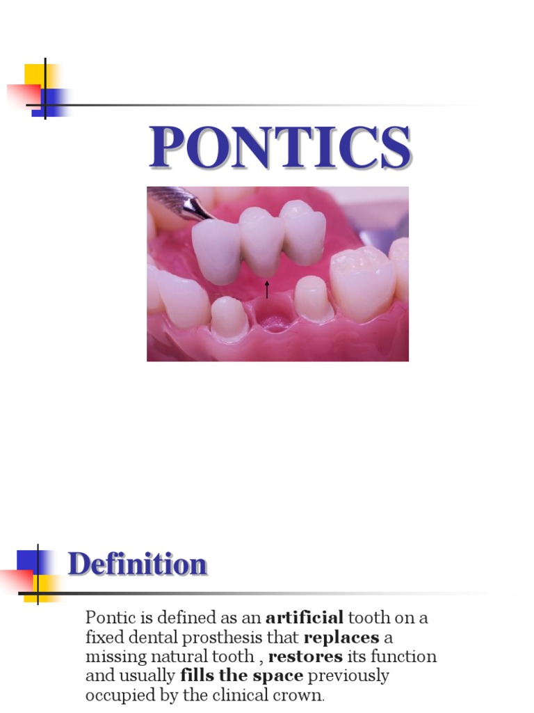 Pontics [Fixed Prosthodontics Seminar AmCoFam] Mouth Dentistry