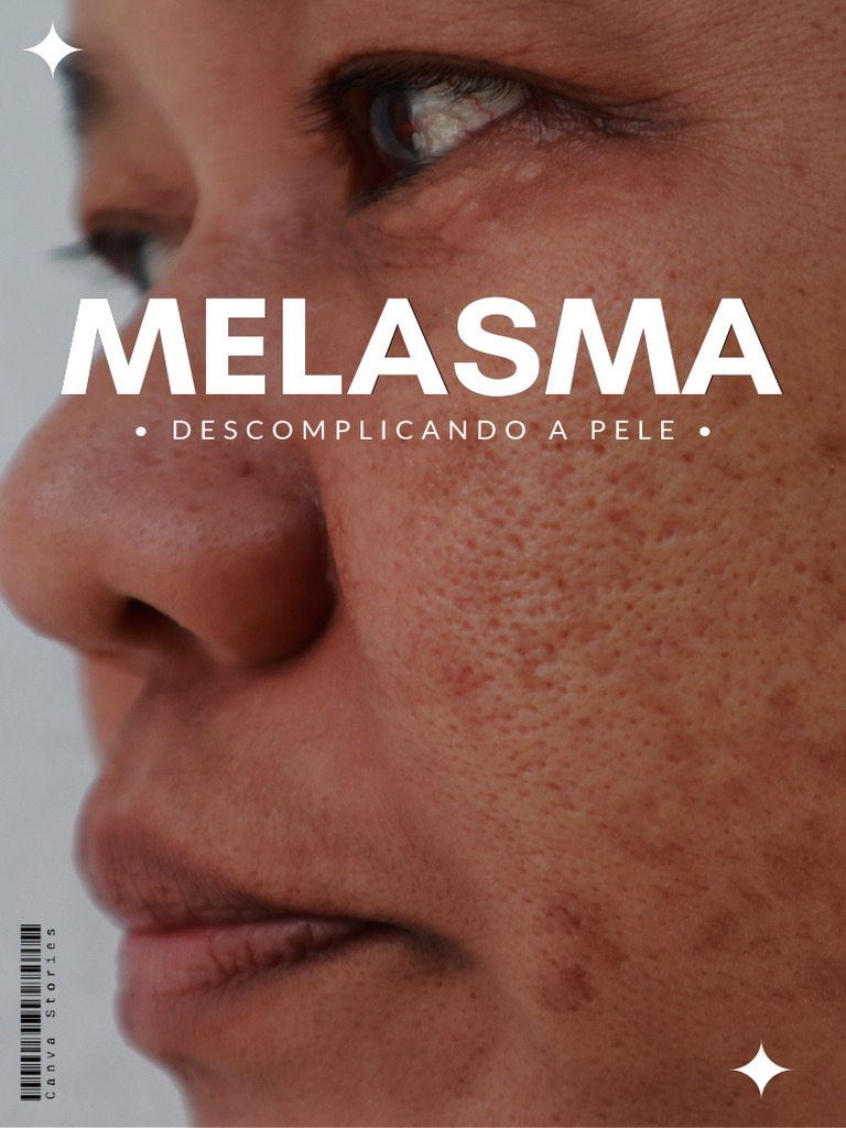 Ebook+ +melasma+ | PDF