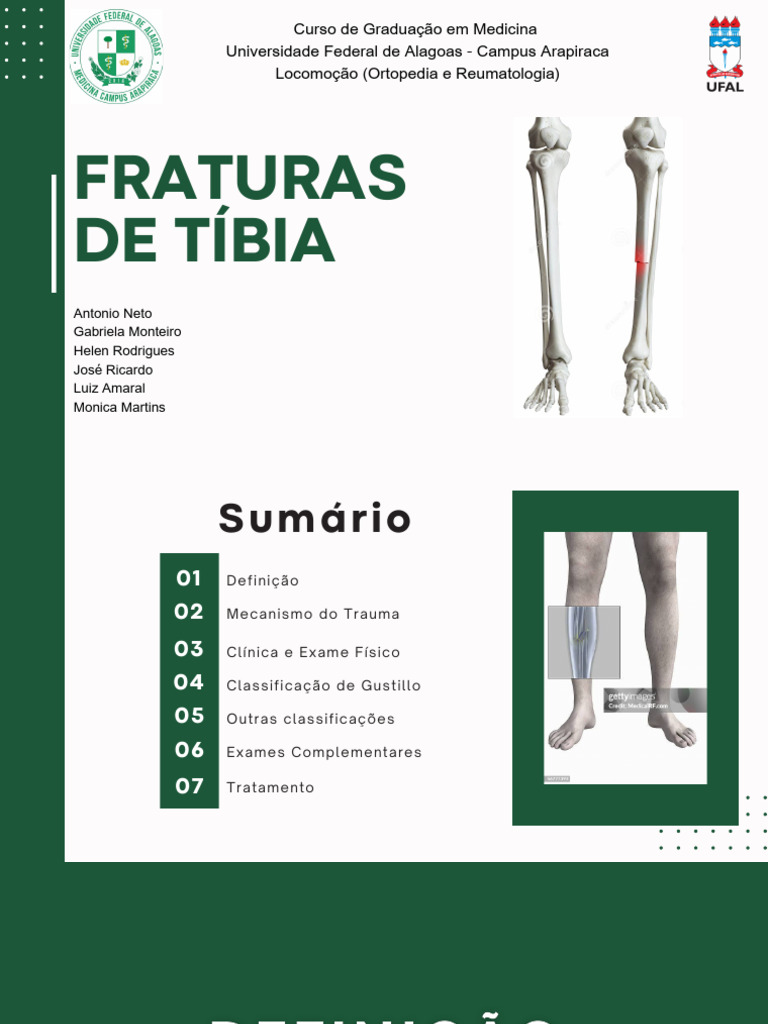Fratura de Tíbia - Turma 8 | PDF