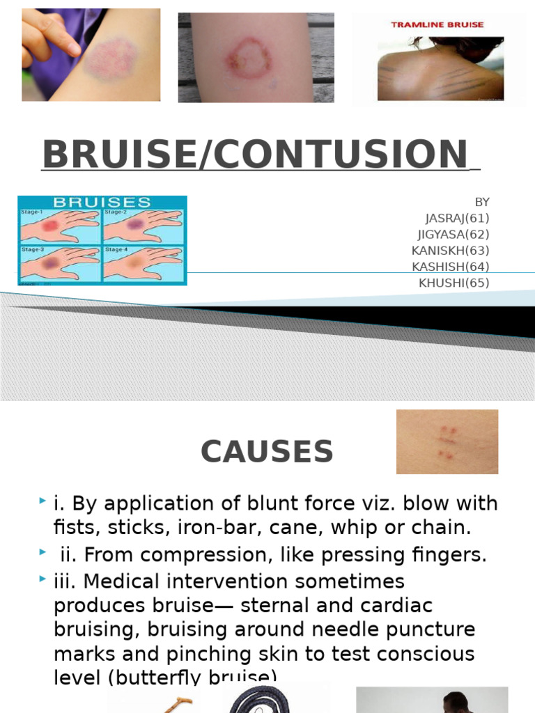 Bruise New12345 | PDF