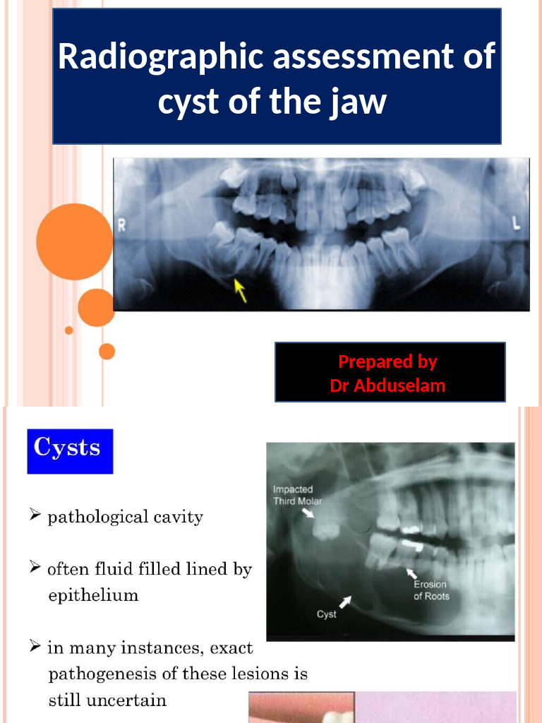 Radiographic Assessment of Cyst of The Jaw | PDF