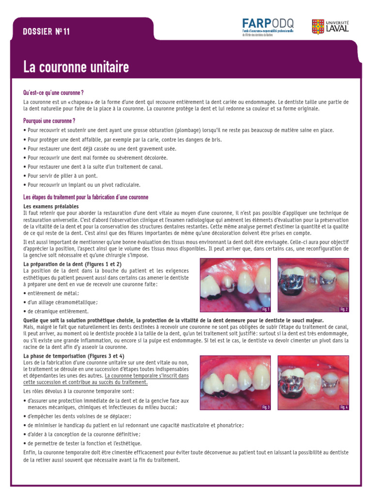 Couronne unitaire : Guide et étapes | PDF | Dentiste | Médecine clinique