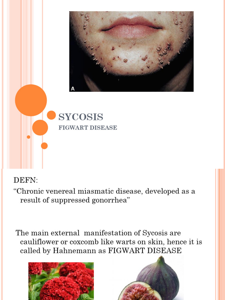 Sycosis | PDF