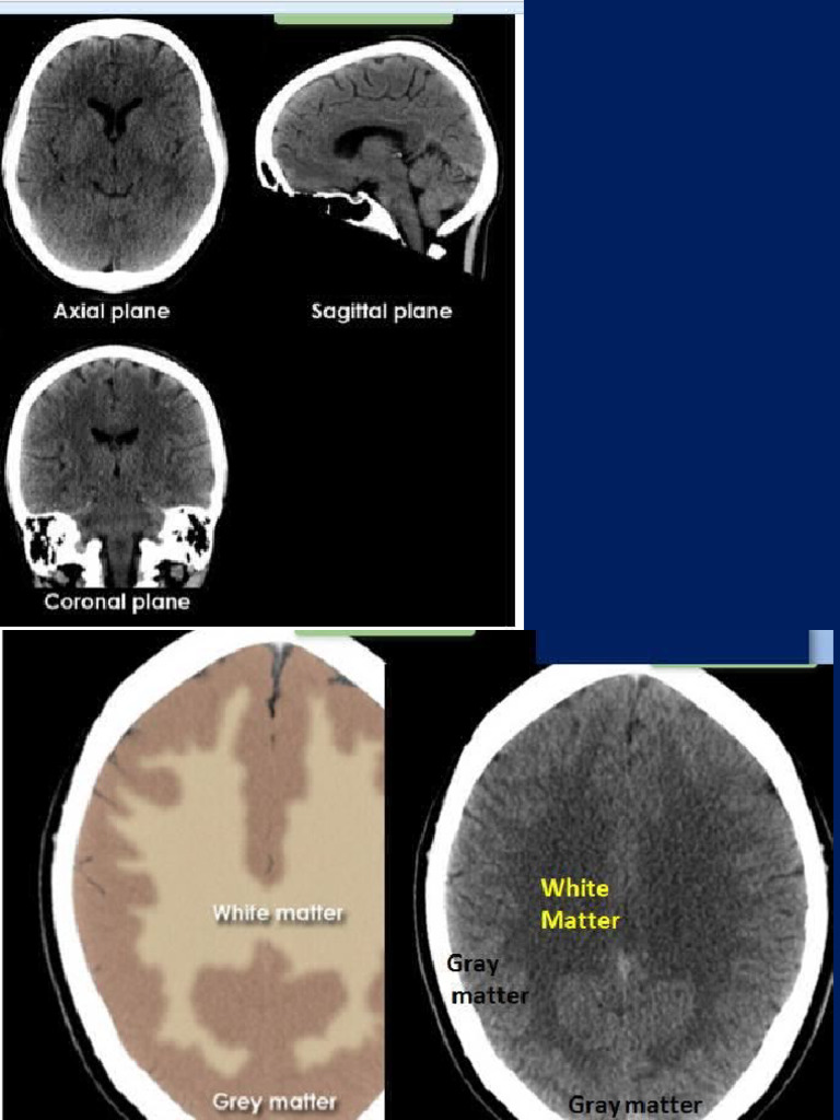 Brain CT | PDF