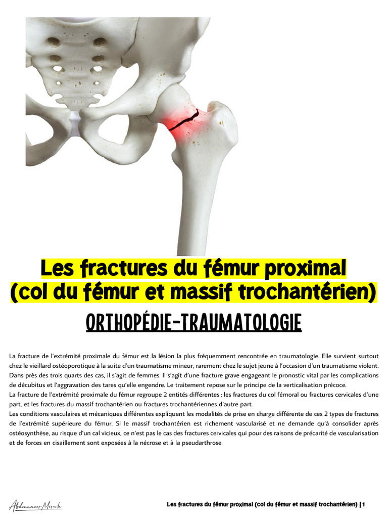 Actures Du Fémur Proximal | PDF