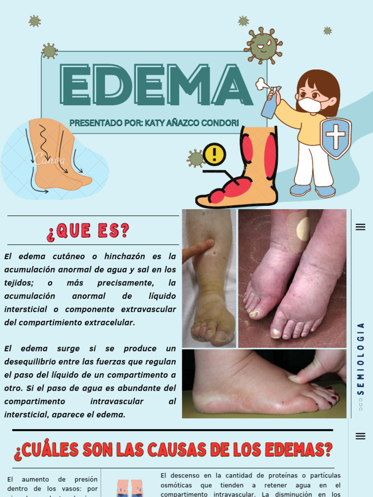 EDEMA | PDF
