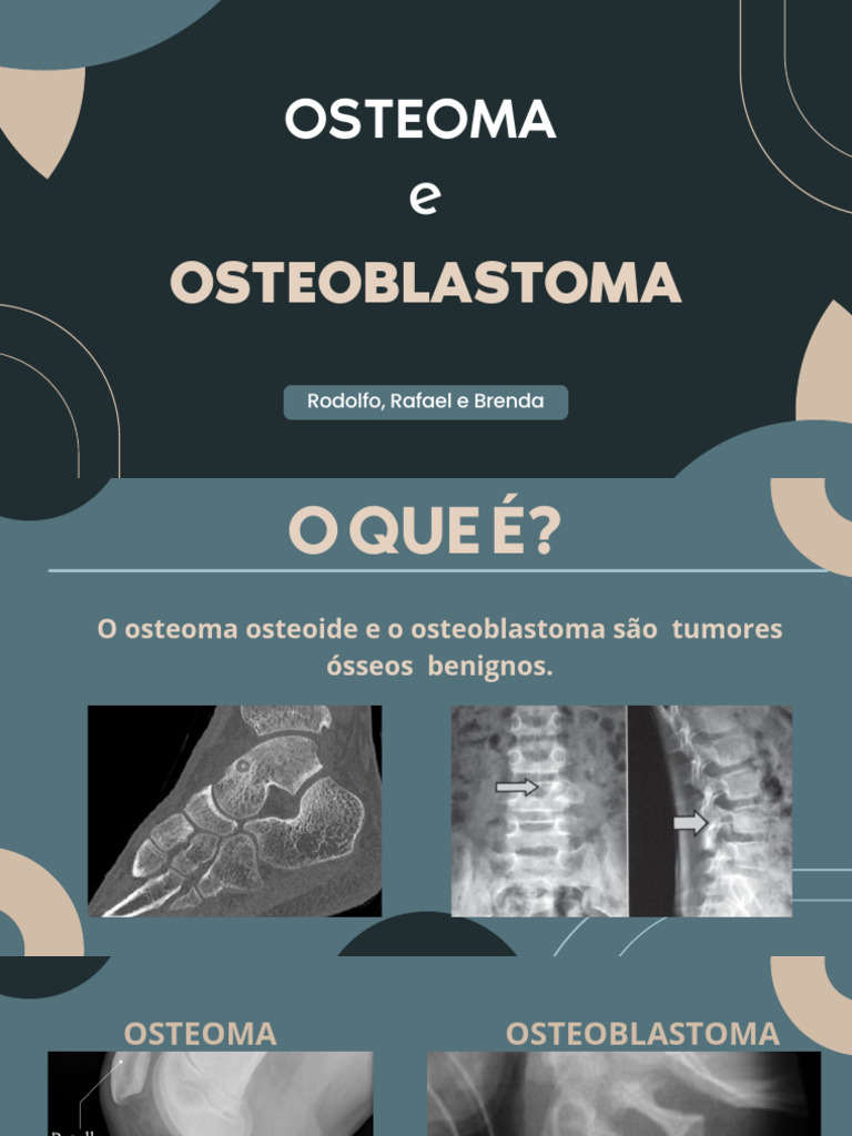 Osteoma e Osteoblastoma - 20240426 - 185035 - 0000 | PDF | Câncer ...