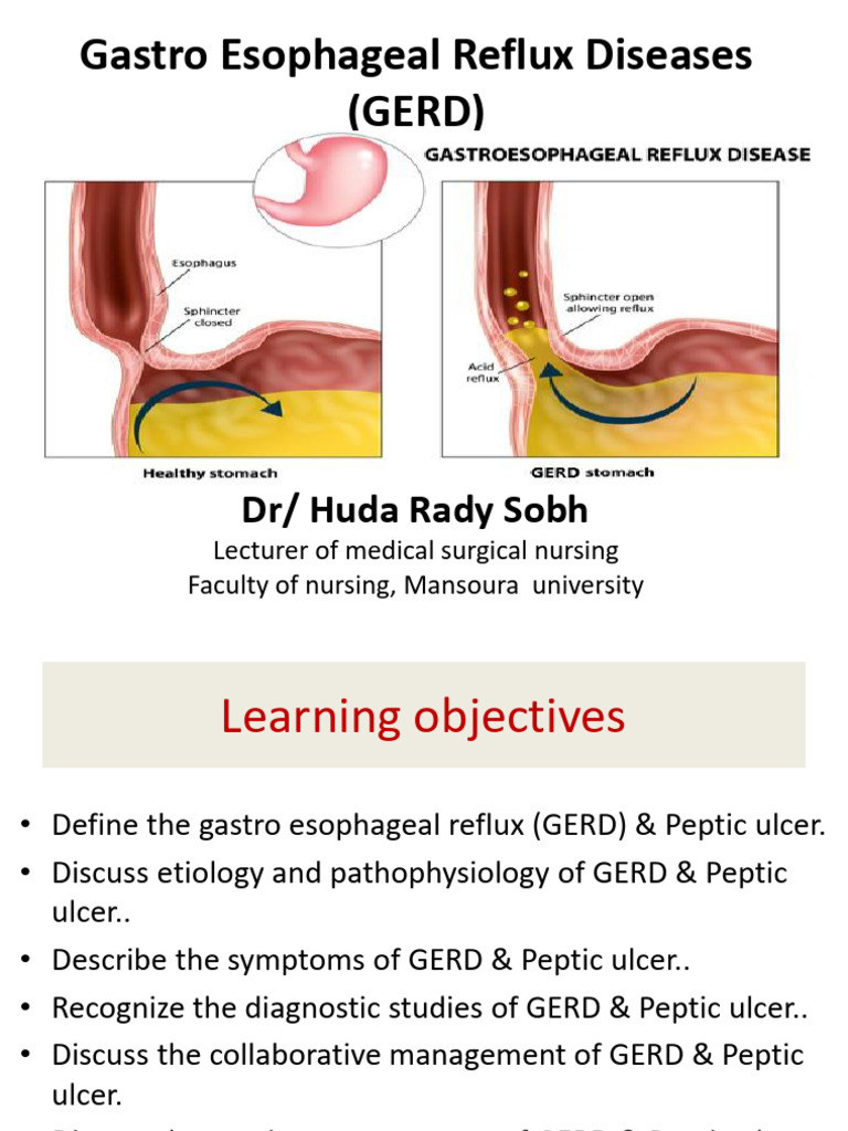 1 - GERD and Peptic Ulcer, Dr. Huda Rady | PDF