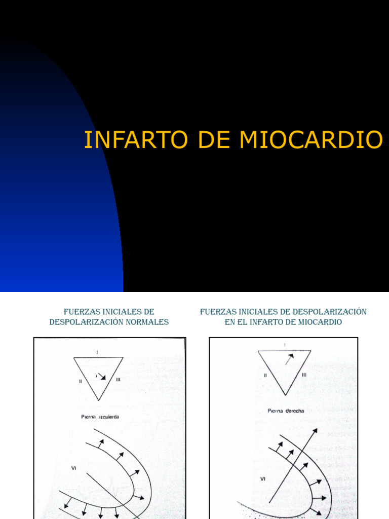 Infarto de Miocardio | PDF | Electrocardiografia | Especialidades Medicas