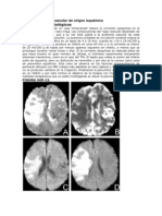 Accidente cerebrovascular isquémico