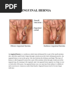 Download Inguinal Hernia by Regine Sitchon SN77840607 doc pdf