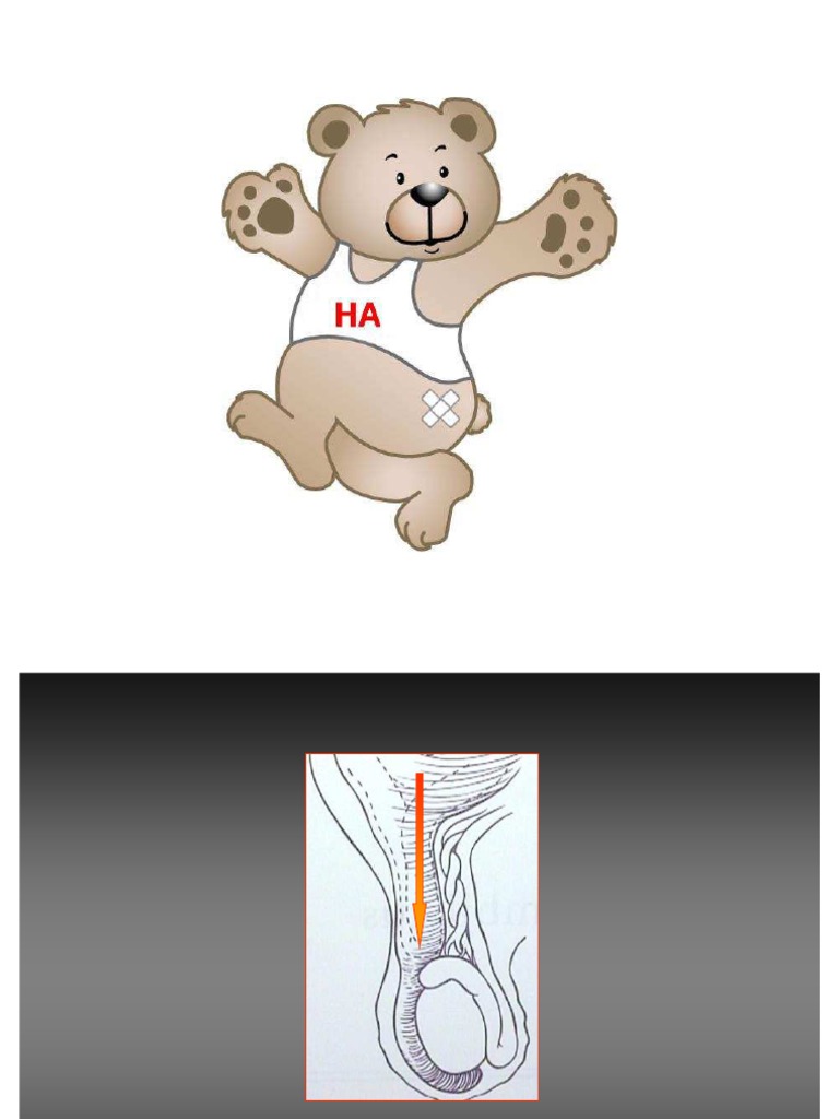 Fotos de Hernia Inguinal