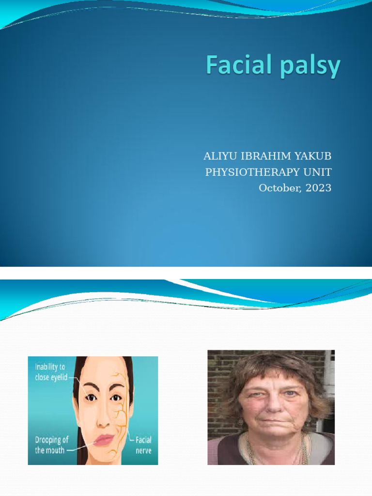 Facial Palsy | PDF