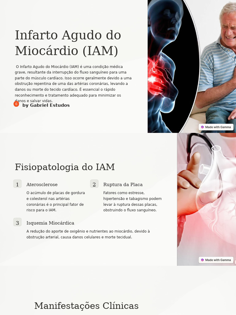 Infarto Agudo Do Miocardio IAM | PDF