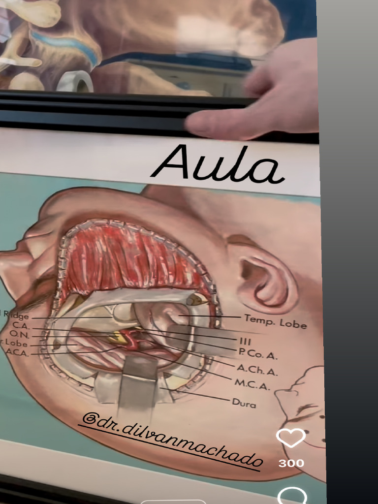 Craniotomia pterional | PDF