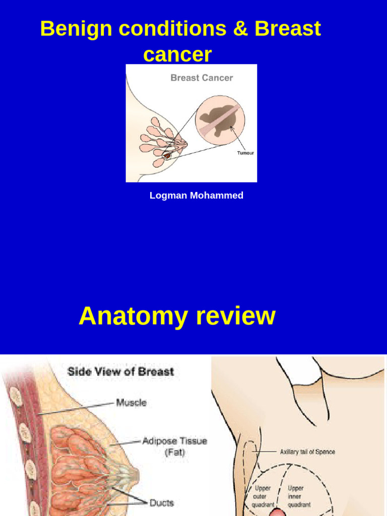 Breat Cancer | PDF