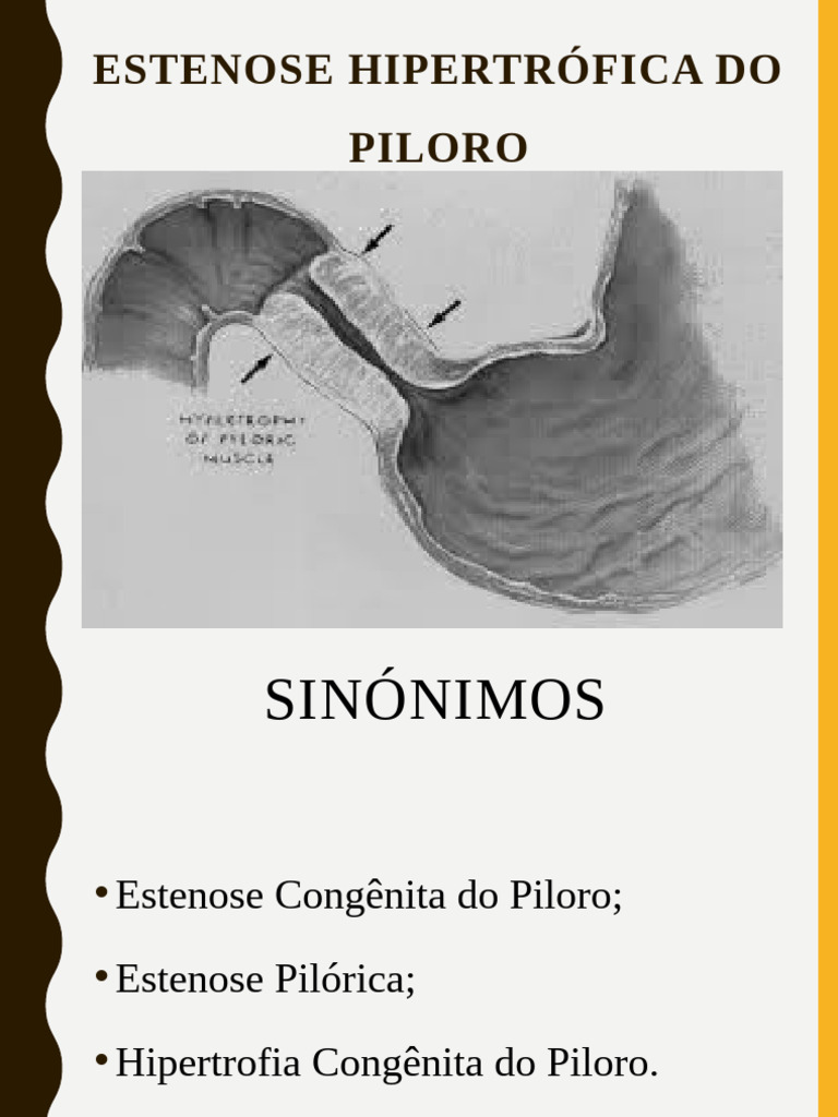 Estenose Hipertrófica Do Piloro1 | PDF