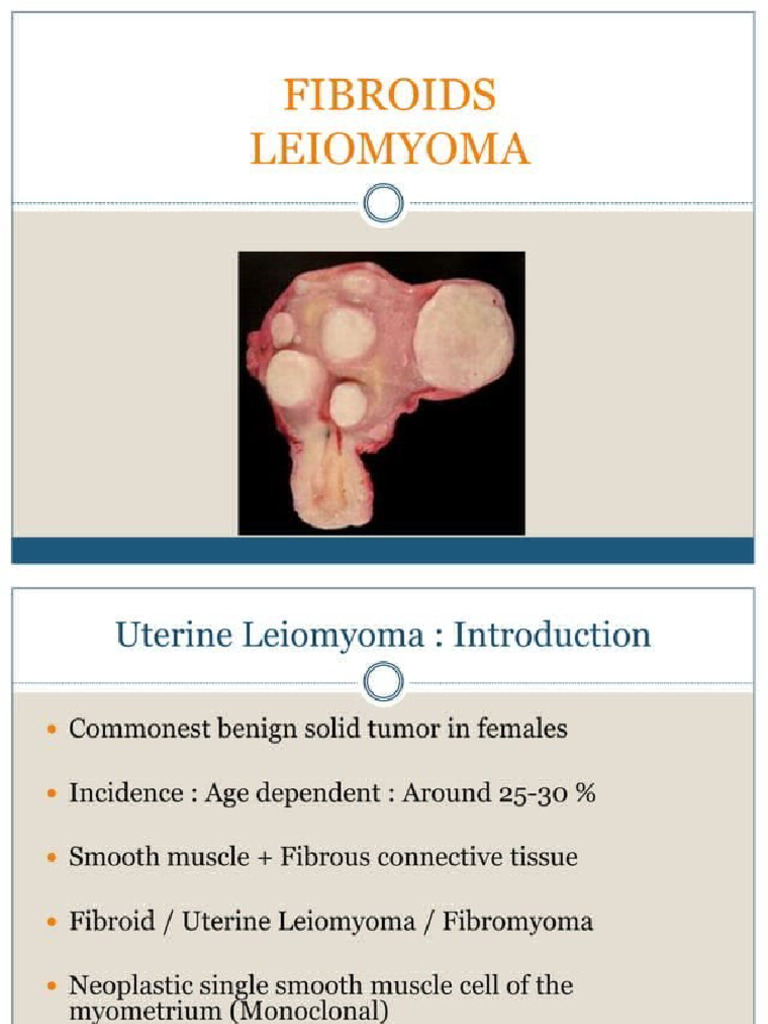 Uterrine Fibroid | PDF