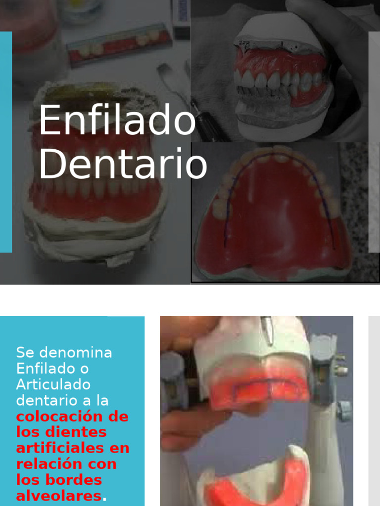 6 - Enfilado Dentario | PDF
