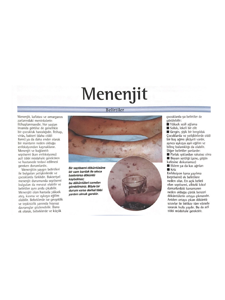 Menenjit | PDF