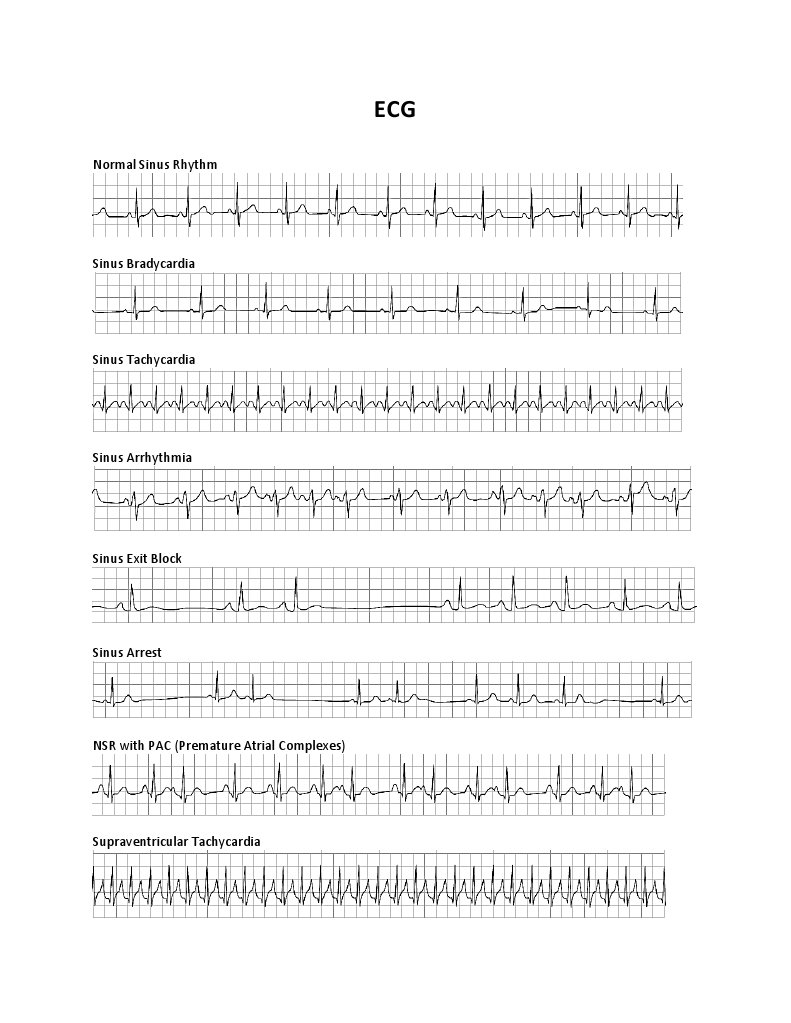 Ecg Strips