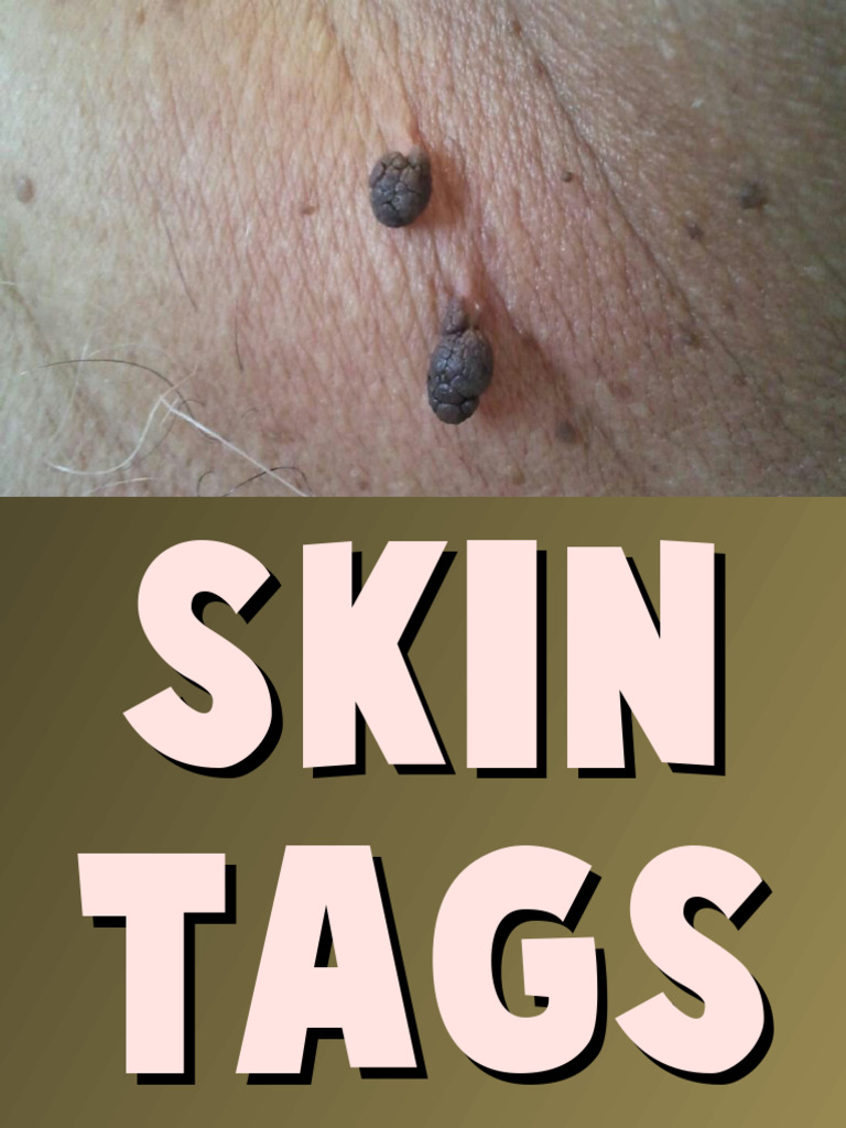 Skin Tags | PDF | Walnut | Oregano