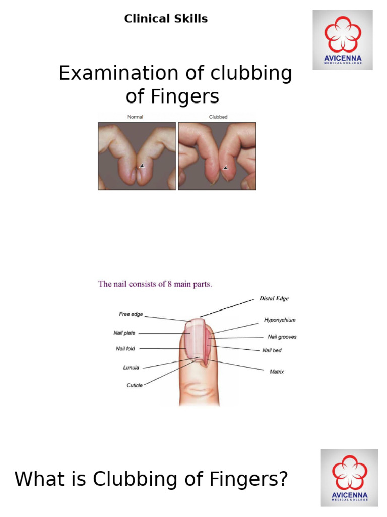 Understanding Finger Clubbing Causes | PDF