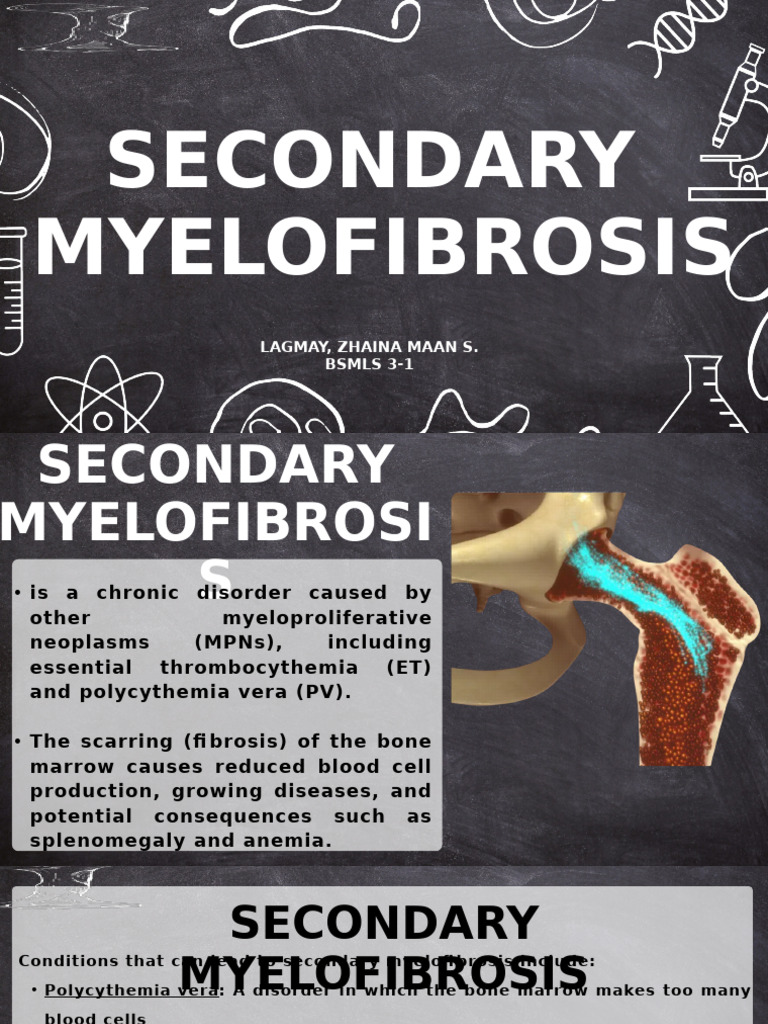 Secondary Myelofibrosis - Lagmay (3-1) | PDF | Tissue (Biology ...