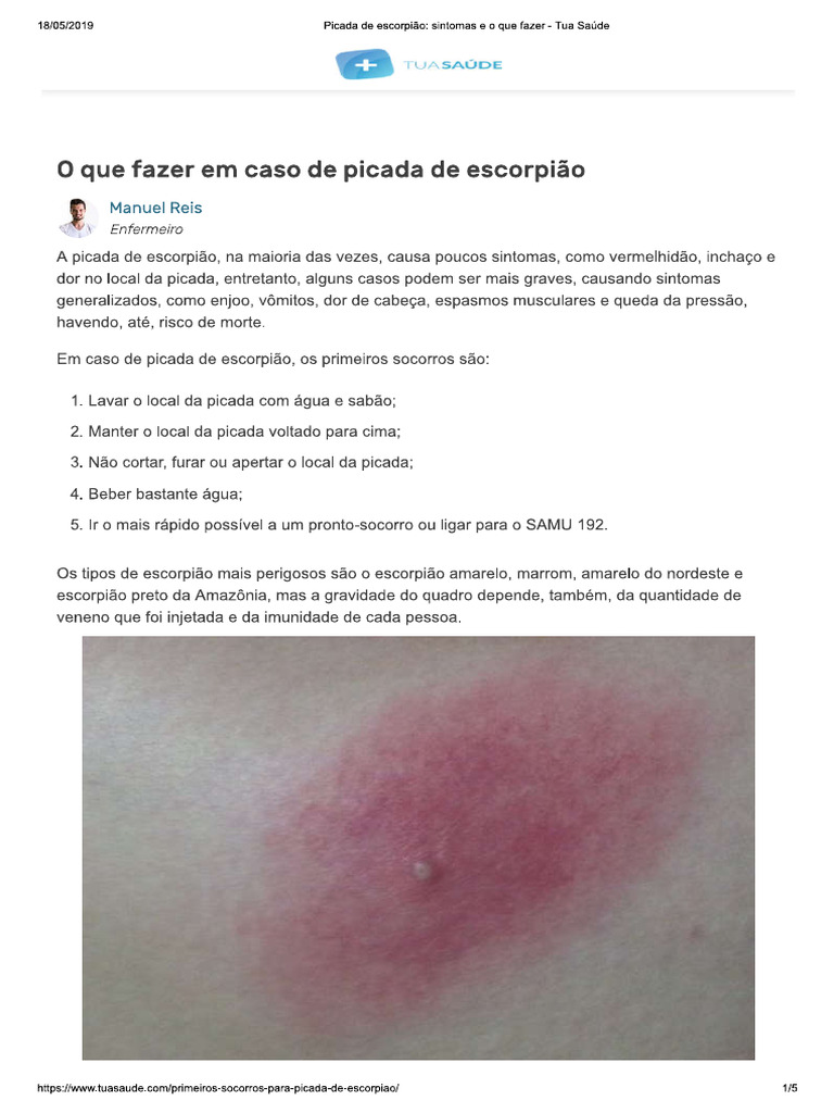 Picada de Escorpião - Sintomas e o Que Fazer - Tua Saúde | PDF