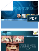 Overdentures options for total tooth loss