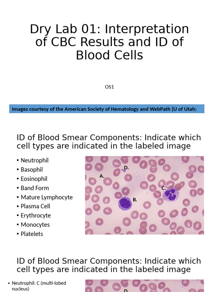 CBC Results Interpretation and Cell ID | PDF | Anemia | White Blood Cell