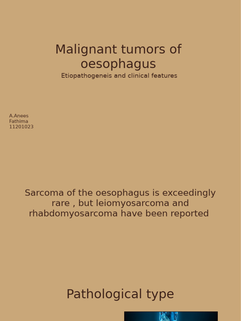 Oesophageal carcinoma | PDF | Esophagus | Esophageal Cancer
