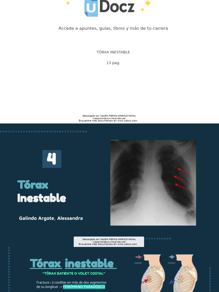 Torax Inestable 976285 Downloadable 1135543 | PDF | Tórax | Respiración