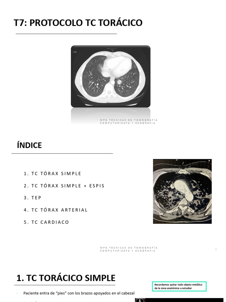 Tema 7 - TC Toracico | PDF | Ct Scan | Corazón