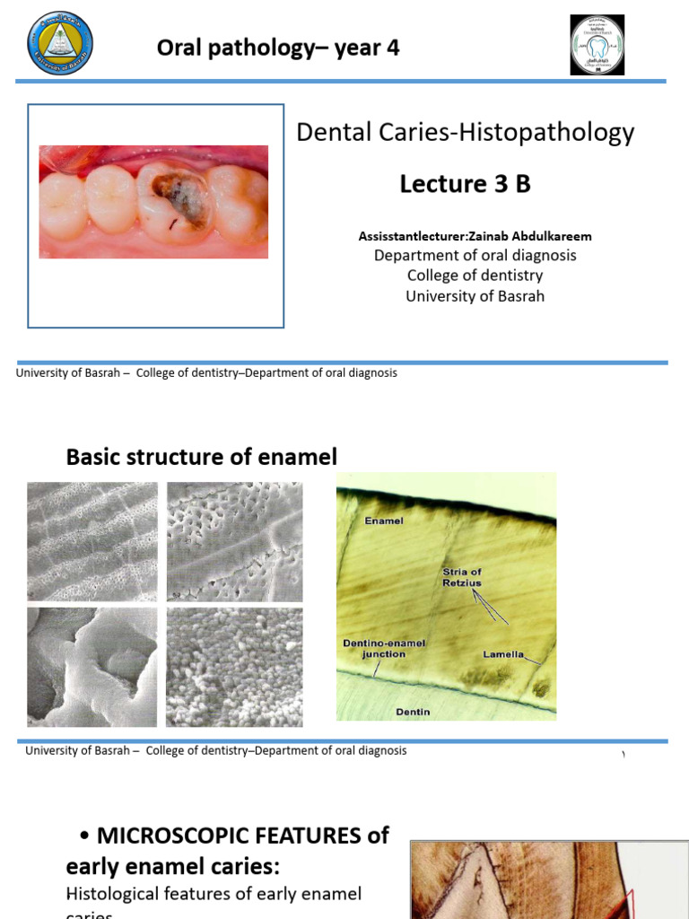Histopathology of Dental Caries | PDF | Dentin | Tooth Enamel