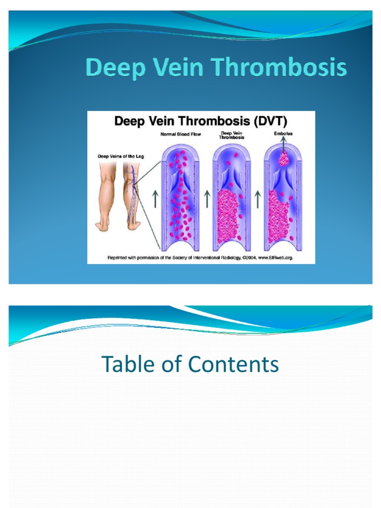 DVT | PDF