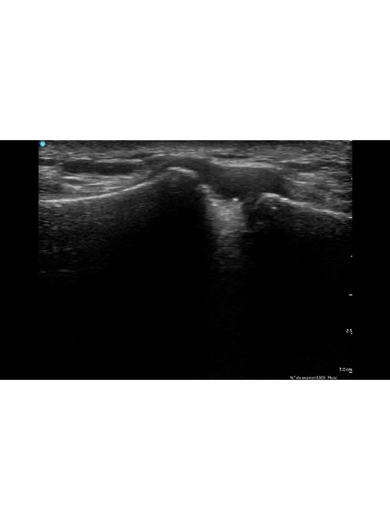Ecografia Acromioclavicular Normal | PDF