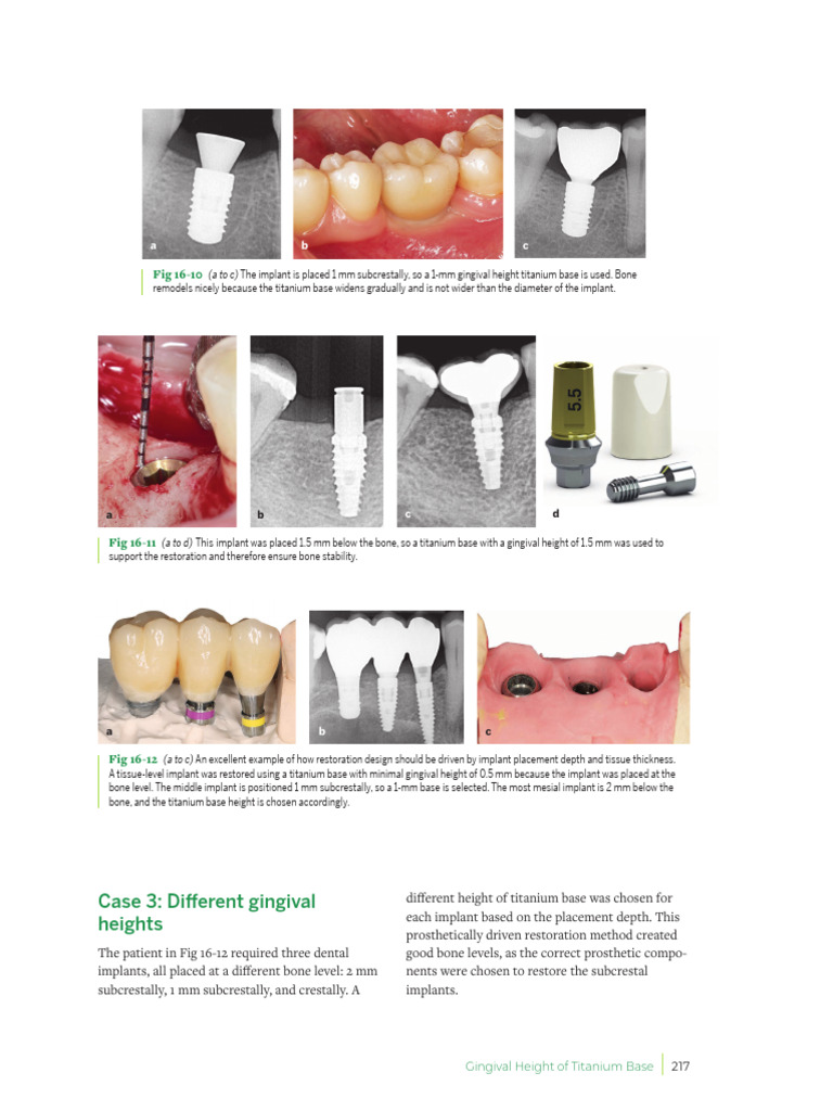 Cap 16-7-11 | PDF | Dental Implant | Dentistry Branches