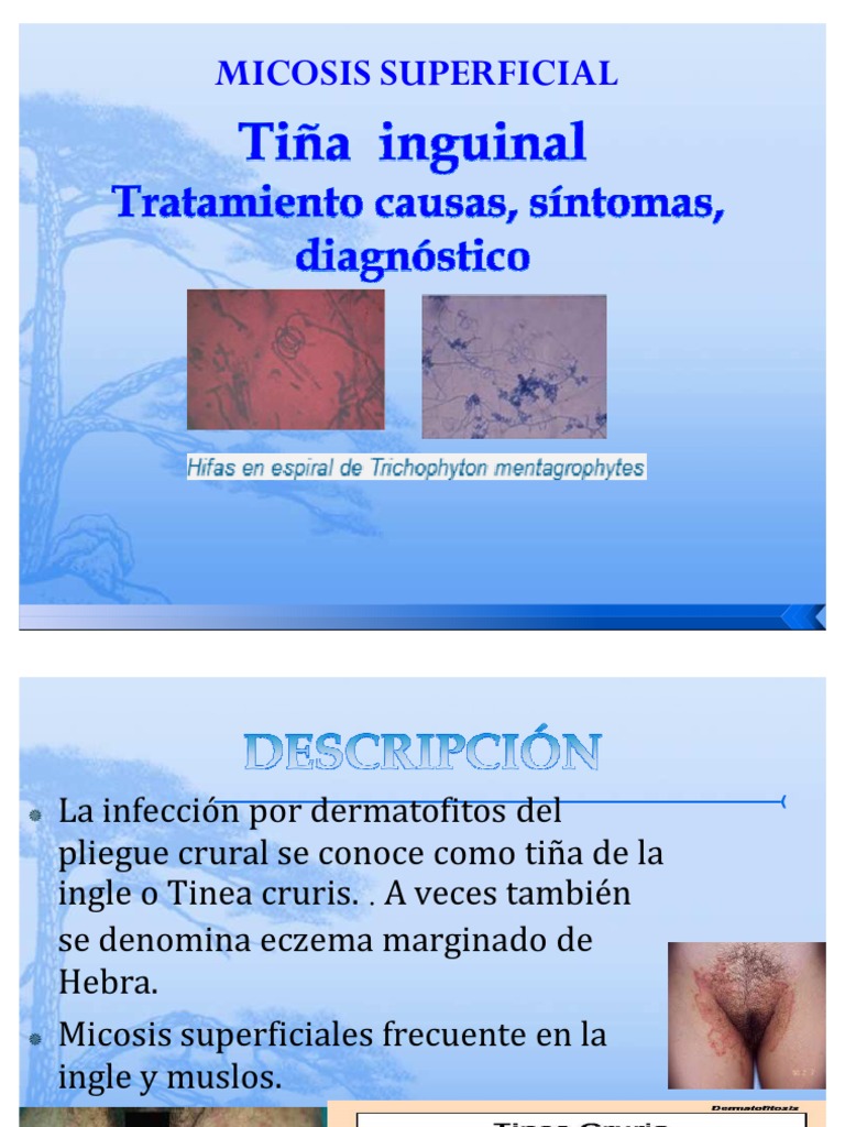 Tratamiento de la tiña inguinal | PDF | Hongo | Inmunología