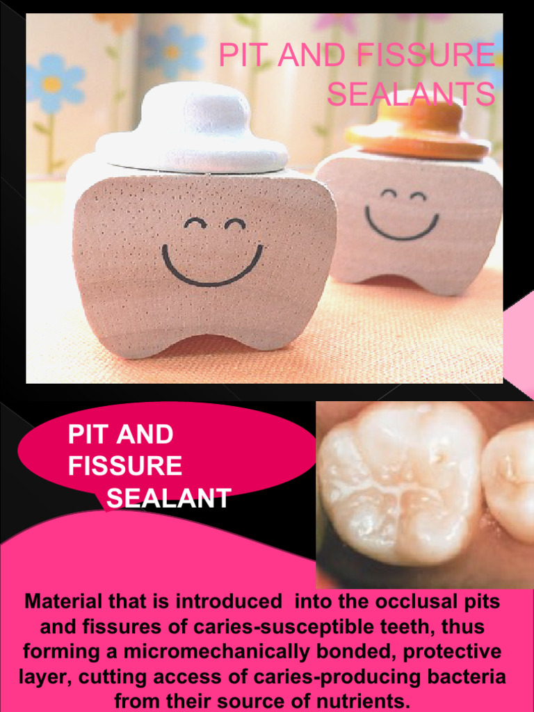 pit-and-fissure-sealants-pdf