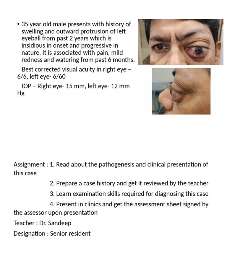 Thyroid Eye Disease Ug Case | PDF