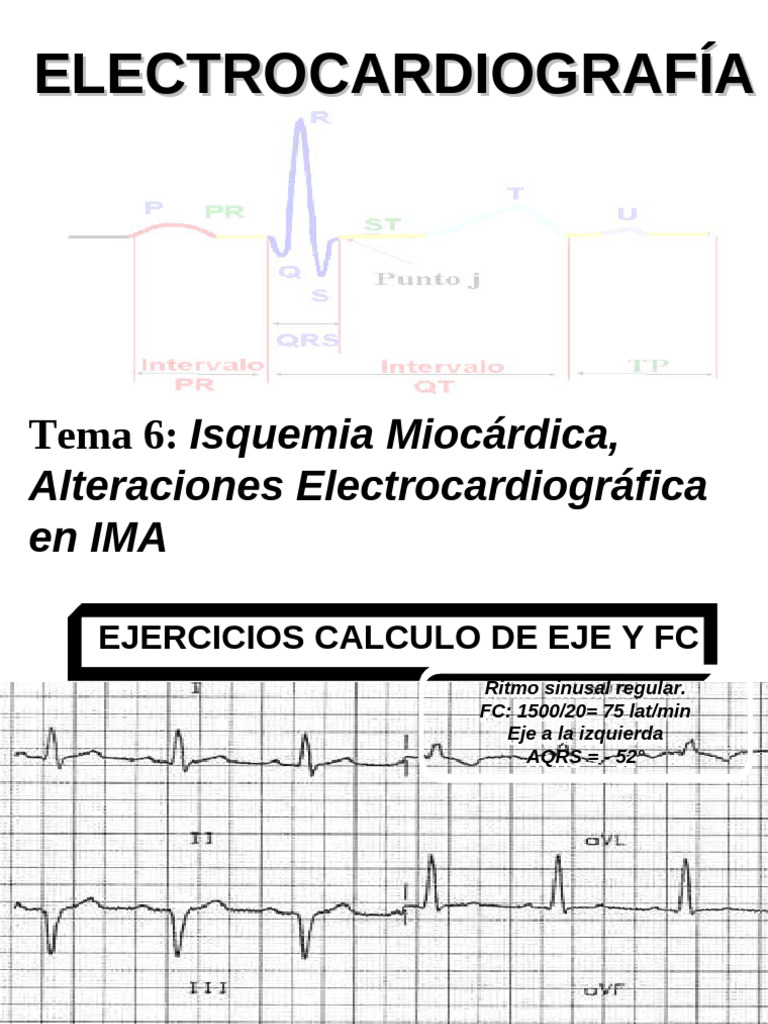 EKG para 3er Año 2 | PDF | Electrocardiografia | Infarto de miocardio