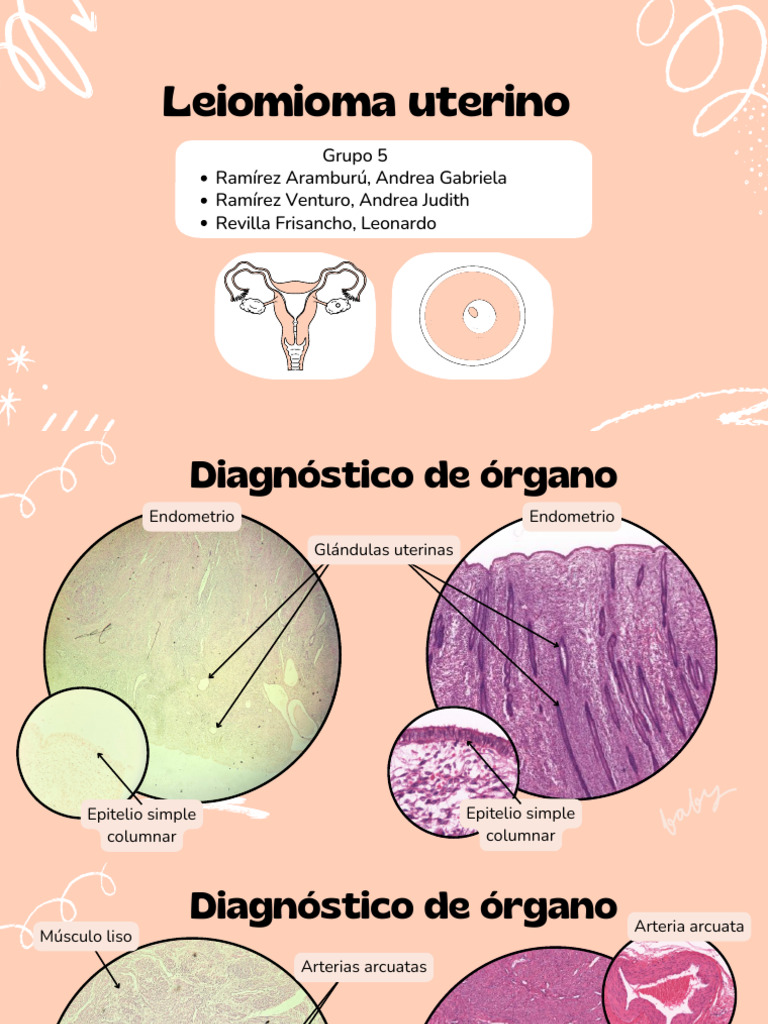 Diagnóstico y Tratamiento de Leiomioma Uterino | PDF | Útero | Menstruación