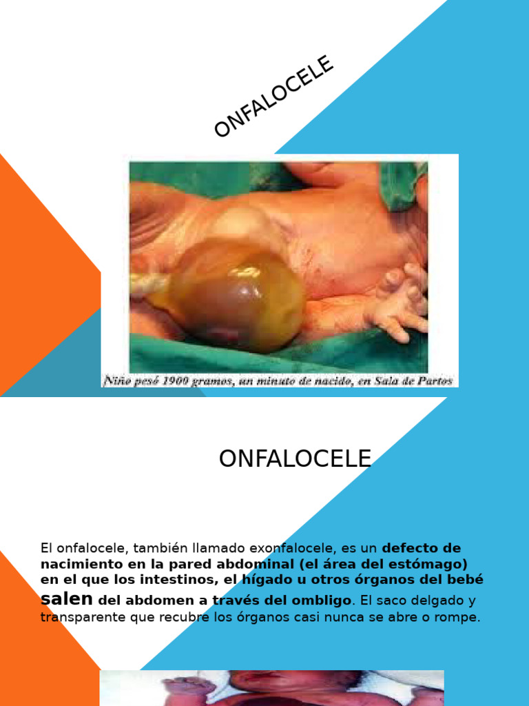 Onfalocele: Definición y Manejo Quirúrgico | PDF | Abdomen | El embarazo