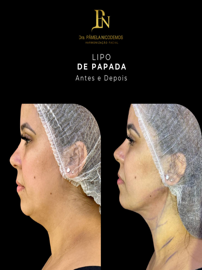 ANTES E DEPOIS - Lipo de Papada 2024 | PDF