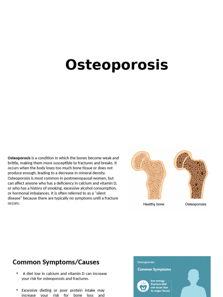 Osteoporosis | PDF