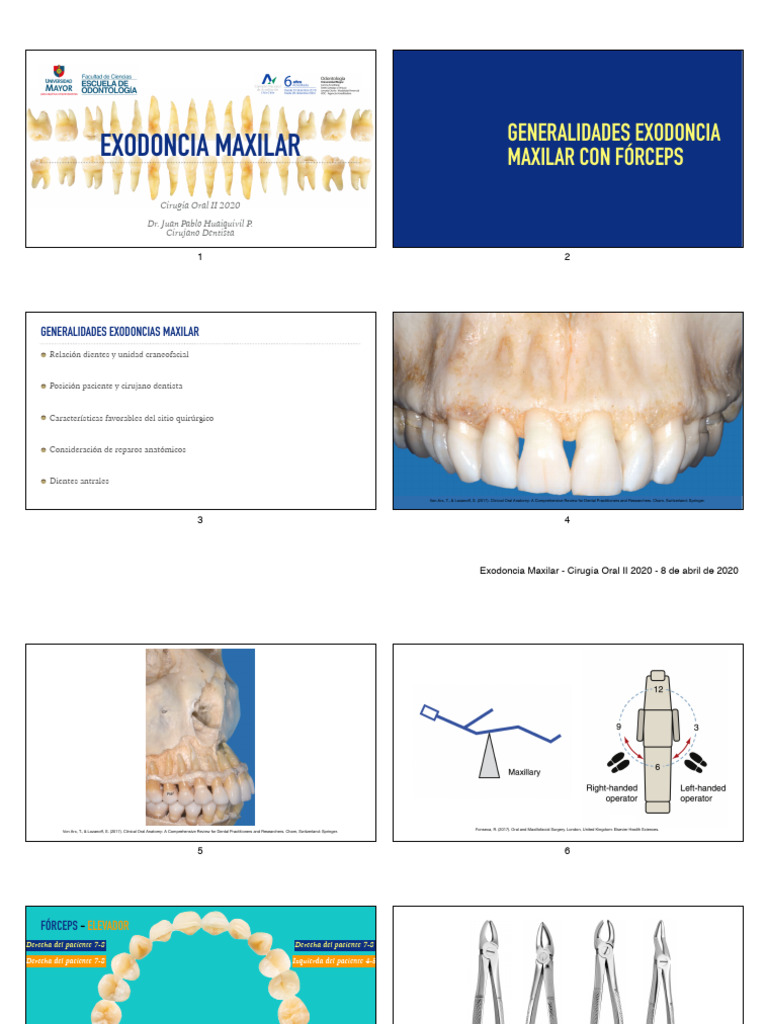 Exodoncia Maxilar | PDF | Odontología | Cirugía