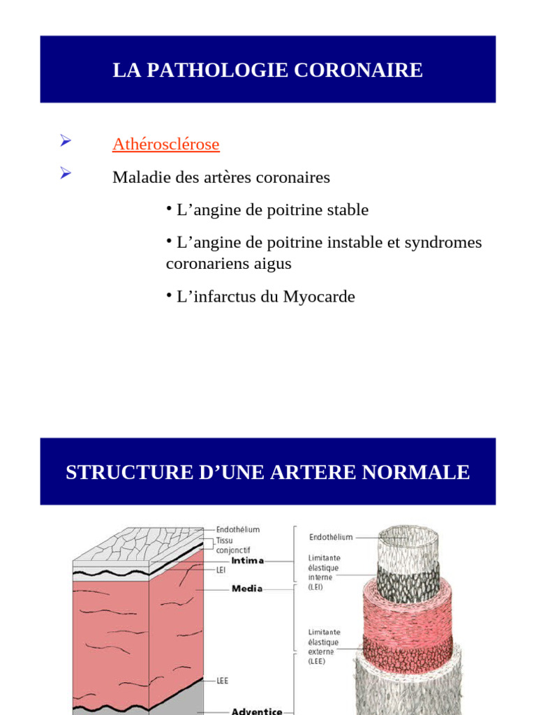 Angine De Poitrine Et Infarctus De Myocarde PDF Infarctus Du 1