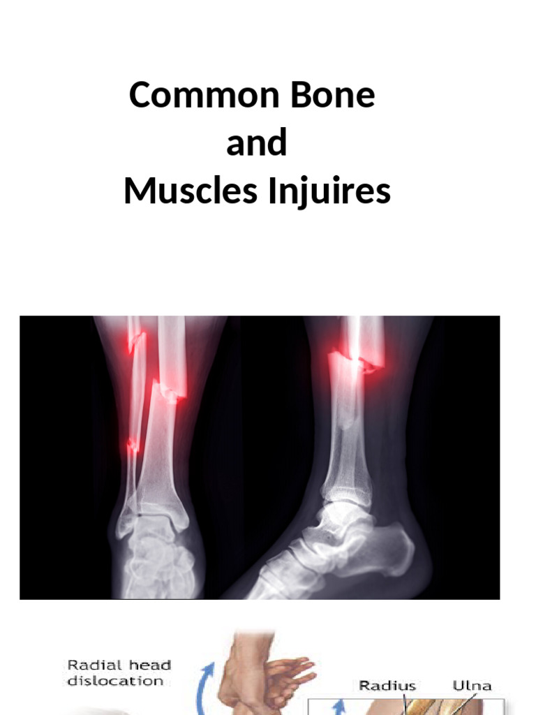 Common Bone Injury Grade 4 | PDF