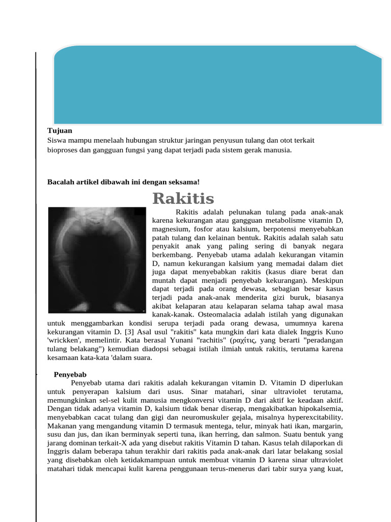 Penyebab dan Gejala Rakitis pada Anak | PDF